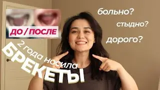 LOOK before getting braces | BEFORE AND AFTER, my experience, story, advice