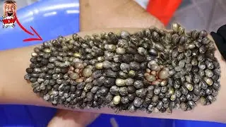 Oh god ! Look How to Remove Giant Ticks on on my Feet #200