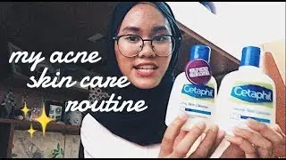 My Acne Story + How I Get Rid of It