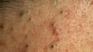 Черные точки вылезли