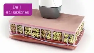 Velashape 3 - RO Medical Art