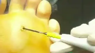 #cornremoval #painfree #clearskin #moleremovaltreatment #jasdeepkaur #sabclinic #dermatology