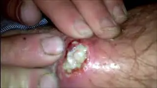 Large Blackheads Cystic Acne Blackheads&Whiteheads Removal Pimple Popping 
