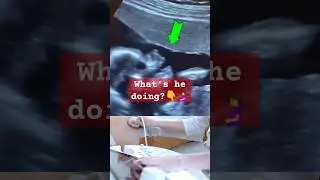 What's he doing?  | Ultrasound #ultrasound #shorts #babyboy #pregnancy