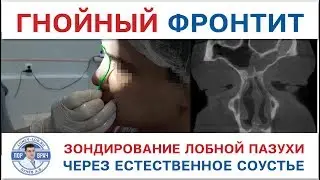 Фронтит. Зондирование лобной пазухи через естественное соустье.