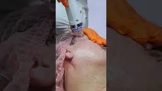 Микроигольчатый RF лифтинг