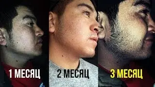 Фотослайд ДО и После, миноксидил 3 месяца