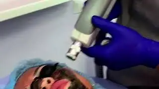 Карбоновый пилинг в Асклепион
