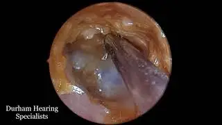 Earwax soup created by sodium bicarb drops suctioned off eardrum