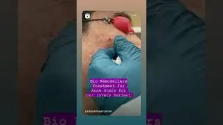 BioRemodellers Treatment for Acne Scars | Open pores reduction |Dr Ashima Goel Chandigarh