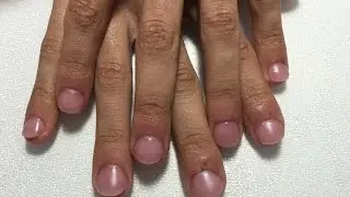 Reconstrucción de uñas mordidas.