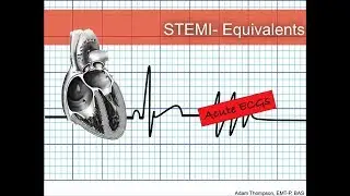 STEMI Equivalents