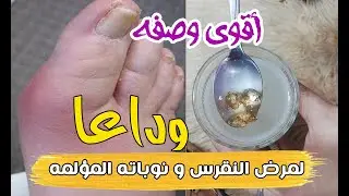 وداعا النقرس نهائيا و نوباته المؤلمة وسخونة القدم والتزم بهذا وخذ هذه الوصفه