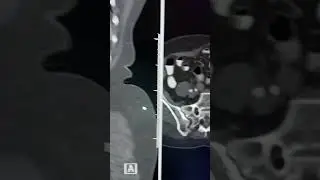 Accessory sacroiliac joint 