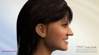 LeFort 1 Advancement (underbite) - Orthodontic Treatment