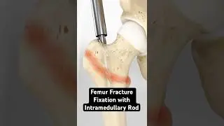 Femur Fracture Fixation with Intramedullary Rod (3D Animation)