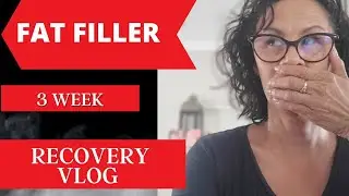 Fat filler to Lip filler vlog/Fat Filler vs Dermal Filler/Before during and After/Pearl Signorile