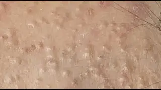 How to treat acne during pregnancy #HoangMySpa122