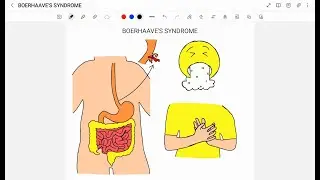 BOERHAAVE'S SYNDROME