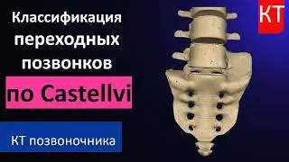 Классификация переходных позвонков по Castellvi