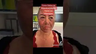 Emprende con Rejuvenecimiento facial con Plasmapen 