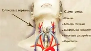 Онкология Головы И Шеи Часть 2