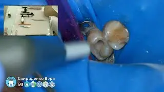 Кариес 17 I-класс Syntec EvoCeram Sanctuary TorVM (прямой эфир)