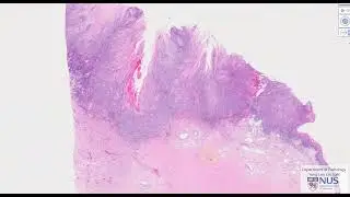 Penis: Squamous cell carcinoma Microscopy (Talking slide)