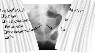 Milkman Fracture