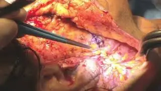 SMAS Platysmaplasty