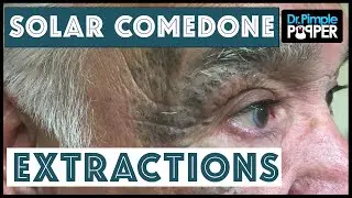Extensive Solar Comedone Extractions, Part 1: Nickname 