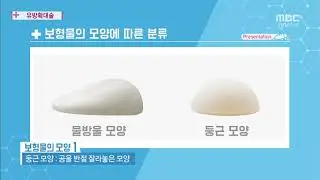 유방확대술