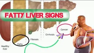 FATTY LIVER Sign & Symptoms | Understanding and Managing FATTY LIVER DISEASE in the Era of Obesity
