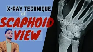 scaphoid view x ray | procedure | process