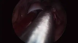 Thoracoscopic Resection of a Massive Atrial Myxoma Causing Functional Mitral Stenosis