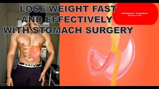how to lose weight fast and effectively with stomach surgery #typesofstomachsurgerytoloseweight