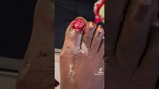 Removal of Toenail