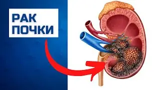 Kidney cancer symptoms, diagnosis and treatment without surgery