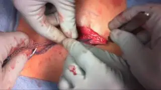 Mesh Sutured Repair Umbilical Hernia