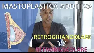 MASTOPLASTICA ADDITIVA - Retromuscolare VS Retroghiandolare