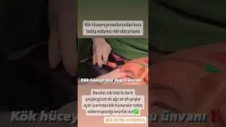 Kök Hüceyrə ilə 15 yaş cavanlaşma #kökhüceyrə #youtubeshorts #plastikcerrah #keşfet