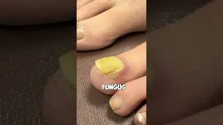 How to Remove Toenail Fungus 😷🩺🩻