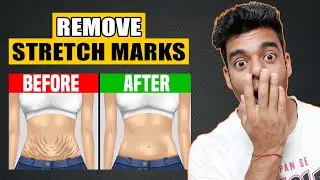 How to Remove Stretch Marks Permanently | Nikhil Nautiyal Fitness
