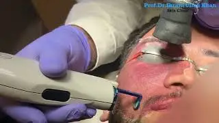 Pulsed Dye Laser Worth the Hype for Port Wine Stains? Find Out Here! #lasertherapy #portwinestain