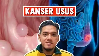 Kanser Usus