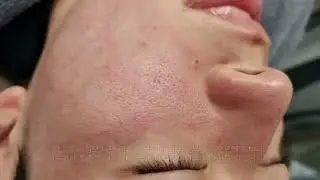 모공, 여드름흉터, 잔주름치료의 종결자 리써FX의 모든 것
