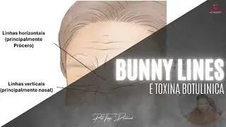 Bunny lines e toxina botulínica