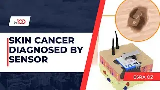 SKIN CANCER DIAGNOSED BY SENSOR