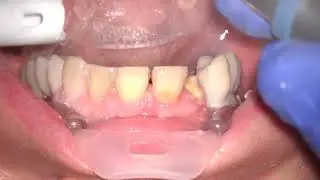 Upper Cosmetic Case Prep Step by Step