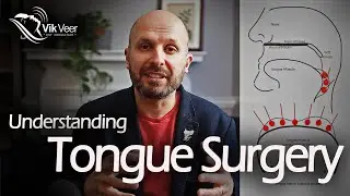 What you Need to Know about Tongue Surgery for Sleep Apnoea